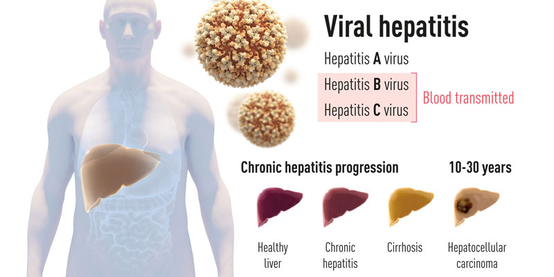 hepatitis